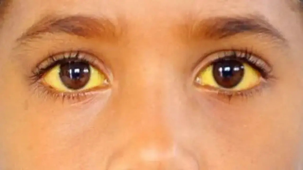 Желтуха и желтизна склер