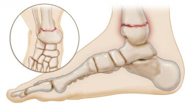 перелом лодыжки